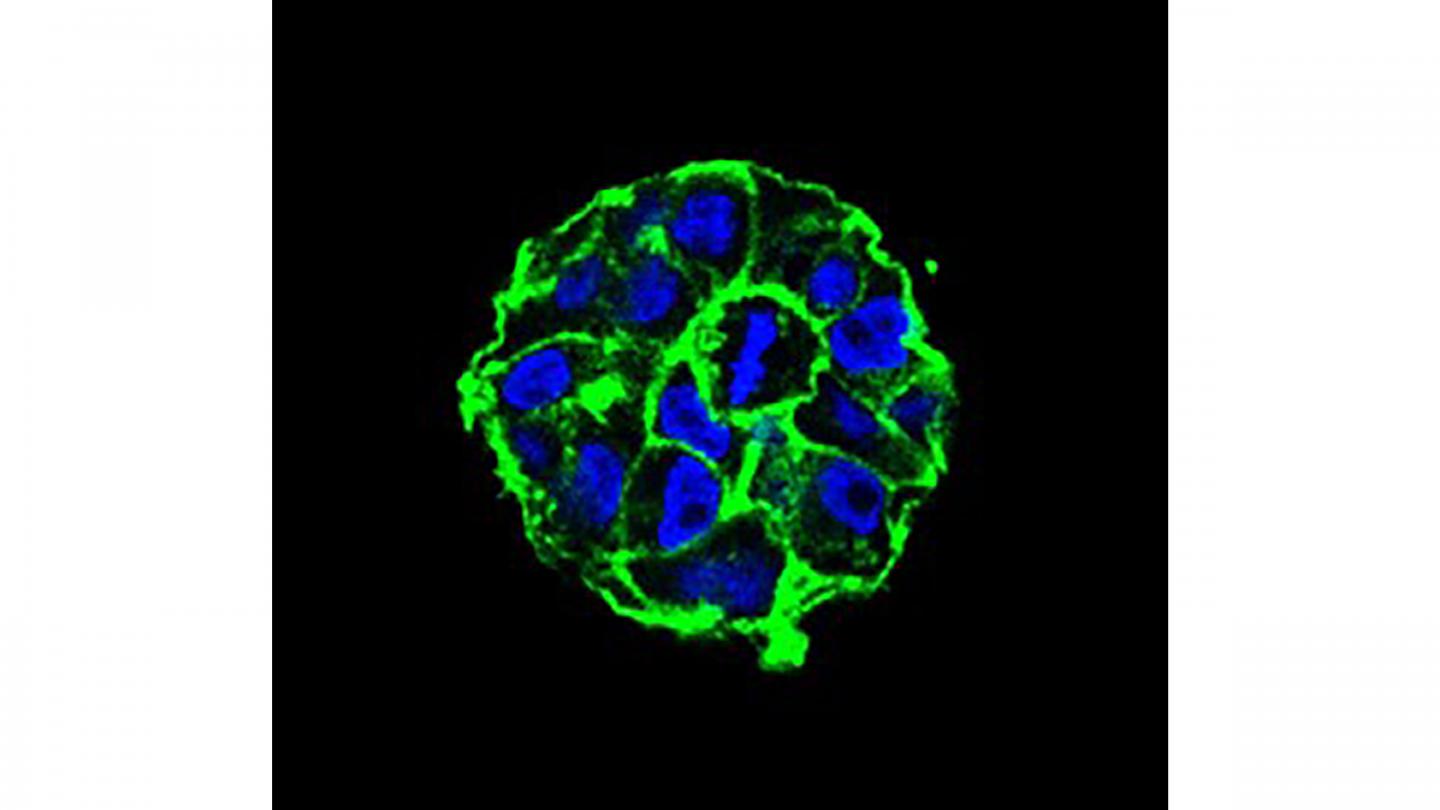 Breast cancer cells forming a tumor spheroid