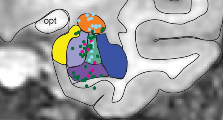 Electrodes in the Amygdala