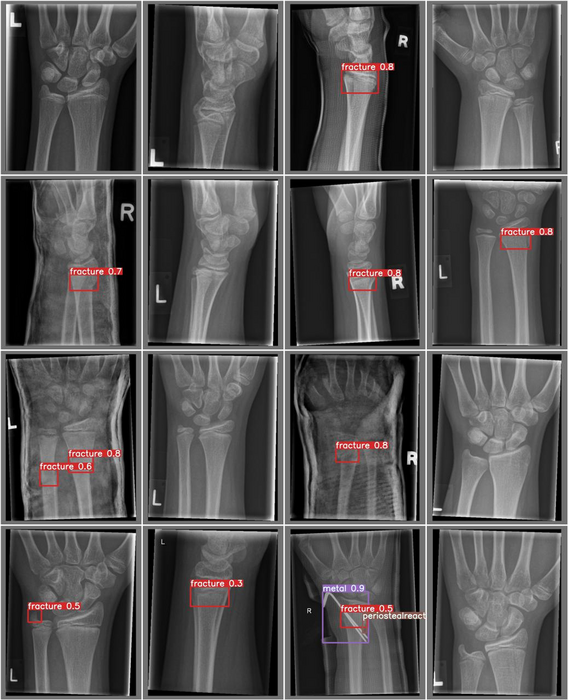 Artificial Intelligence Detection of Wrist Fractures