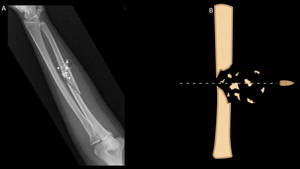 Radiographs of Left Forearm in Gun Shot Injury