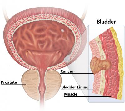 Muscle-invasive Bladder Cancer
