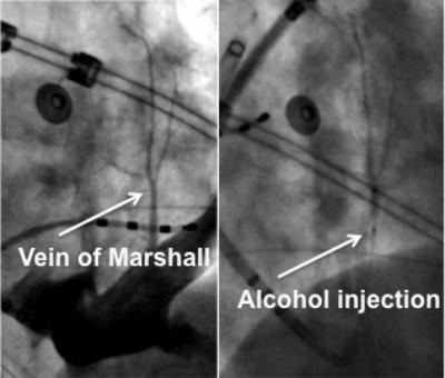 Alcohol Injection at Vein of Marshall
