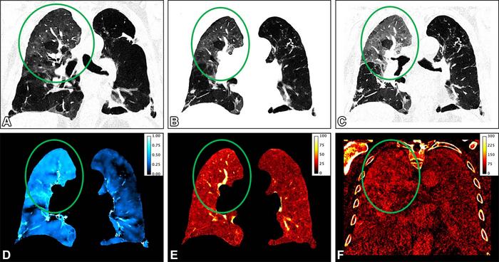 Representative coronal images obtained in an 82-year-old male patient with persisting shortness of breath 1 month after COVID-19 infection.