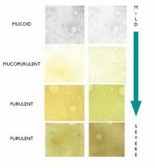 Sputum colour: a useful clinical tool in non-cystic fibrosis bronchiectasis