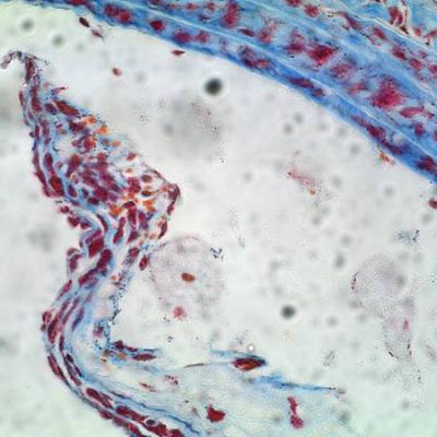 Close-Up of Ruptured Plaque