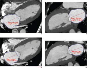 LAVmax (A and B), LAVmin (C and D), and LAEF Using Cardiac CTA