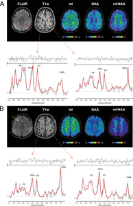 New MRI Technique Detects MS Brain Changes Earlier