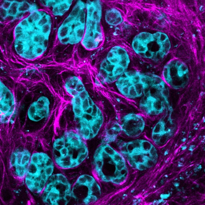 Pancreatic cancer cells activate the molecule AKT (blue) to multiply and spread along connective stroma (pink) in the cancer environment.