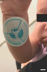 Soft "Sweat Stickers" May Streamline Diagnosis of Cystic Fibrosis in Children (2 of 3)
