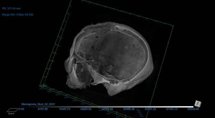 CT Scan of skull