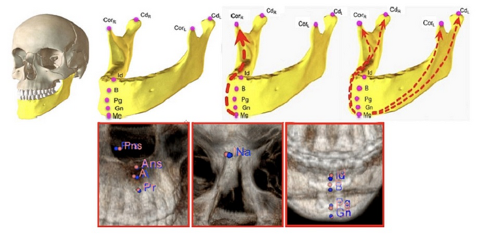 A novel deep learning architecture, the “relational reasoning network,” can learn the spatial relationships between key anatomical landmarks of craniomaxillofacial bones from computed tomography images.