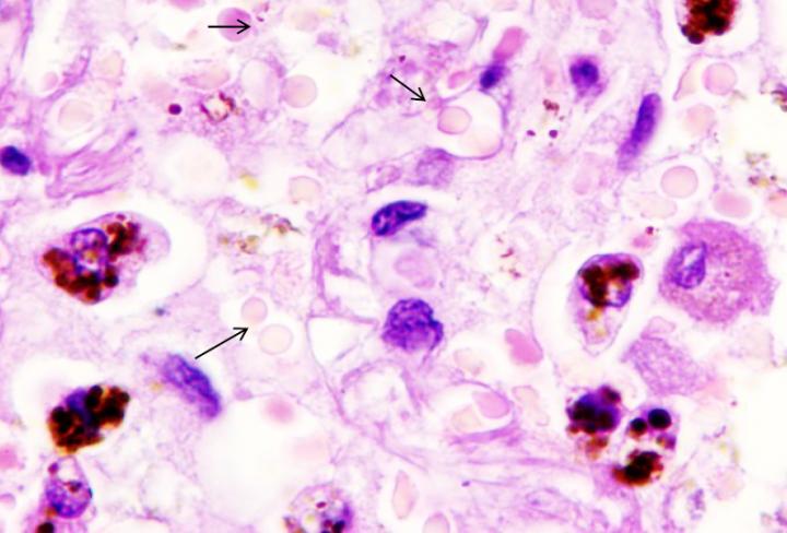 Lung Parenchyma Of Patient