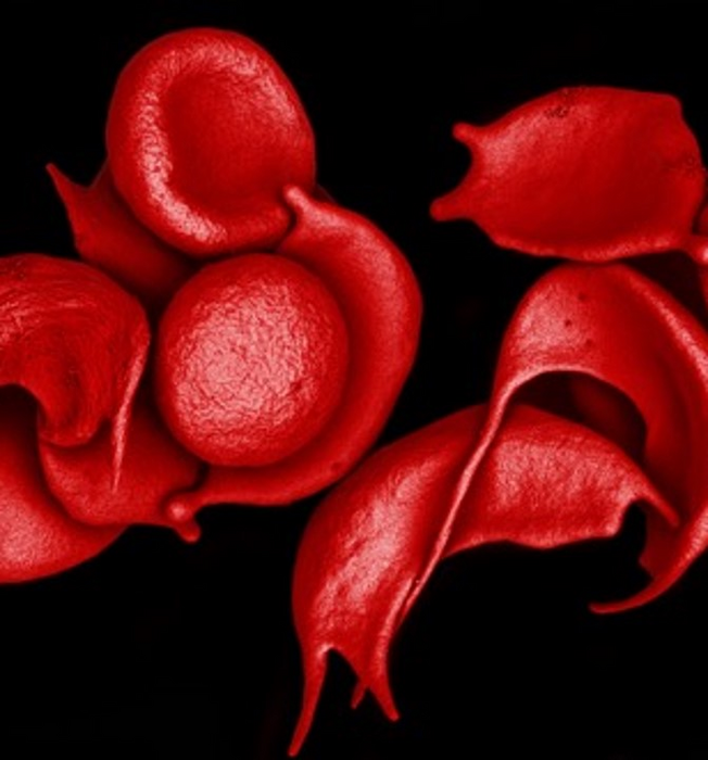 Human red blood cells with sickle cell disease