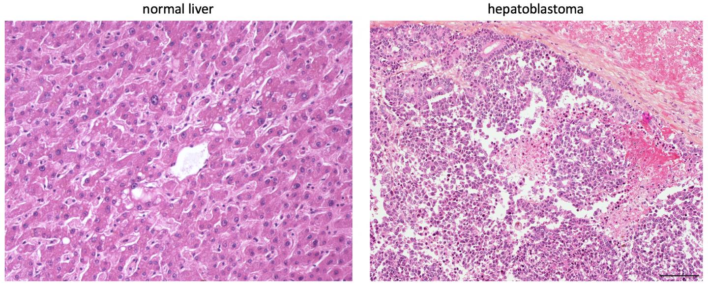 Comparison of Normal vs. Hepatoblastoma Tissue