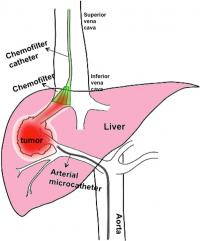 Diagram: A New Treatment System for Liver Cancer