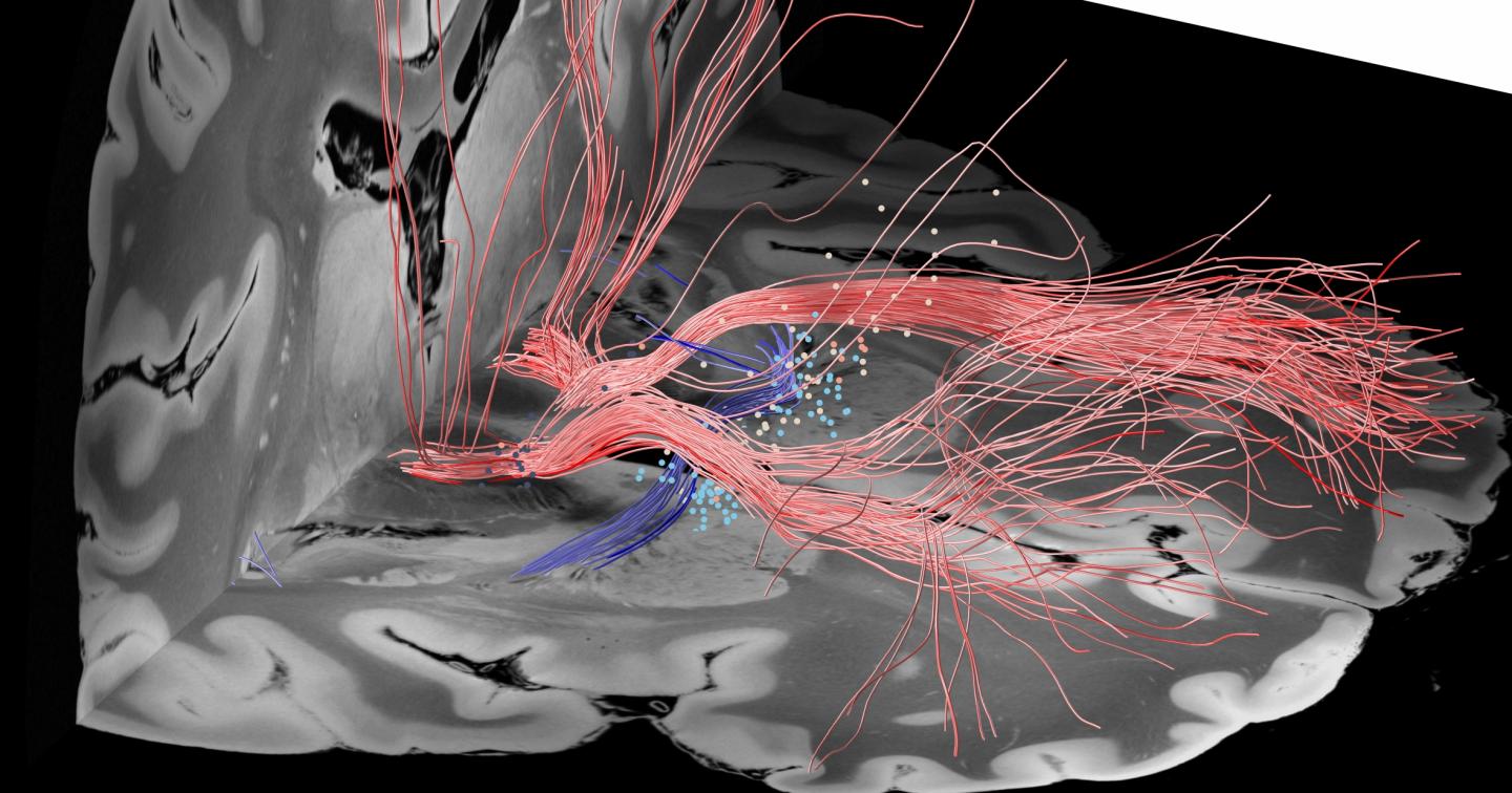 Fiber Tracts within the Target Area for Deep Brain Stimulation