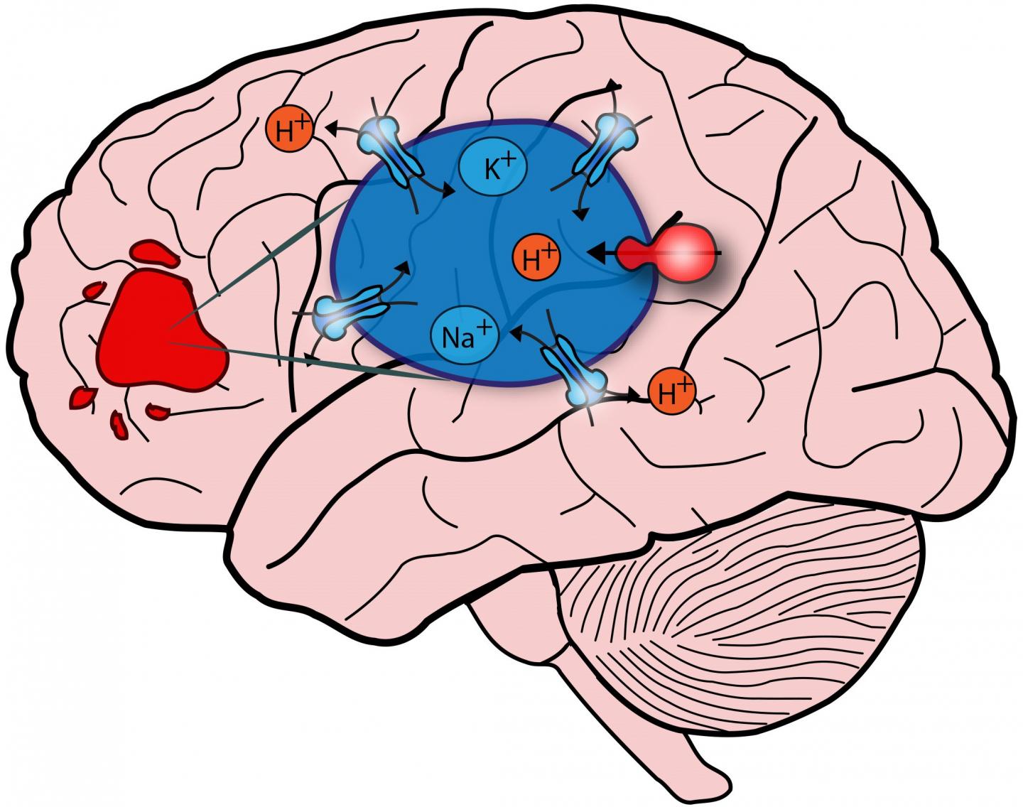 NHE9 Causes Alkaline Endosomes in Certain Brain Cancers