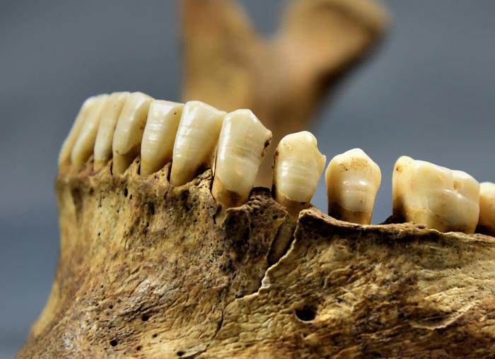 Visible malformations in tooth enamel