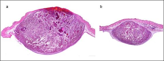 DPP4 Inhibition Blocks Tumor Growth