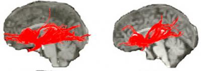 Aberrant Long-Distance Connections