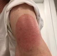 Allergic reaction to covid vaccine uk lump on injection site