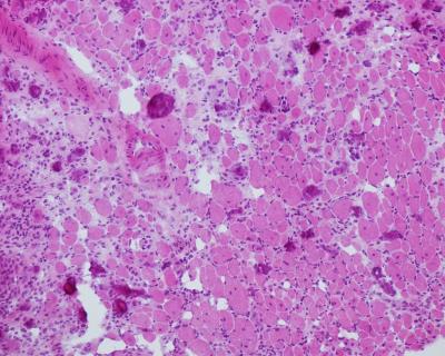 Muscle Tissue After Sepsis