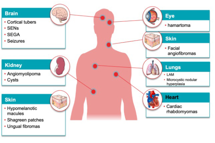 Tuberöse Sklerose: Faktoren, die den Erfolg einer Operation bestimmen