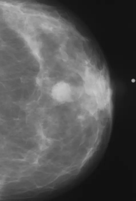 Abnormal Mammogram