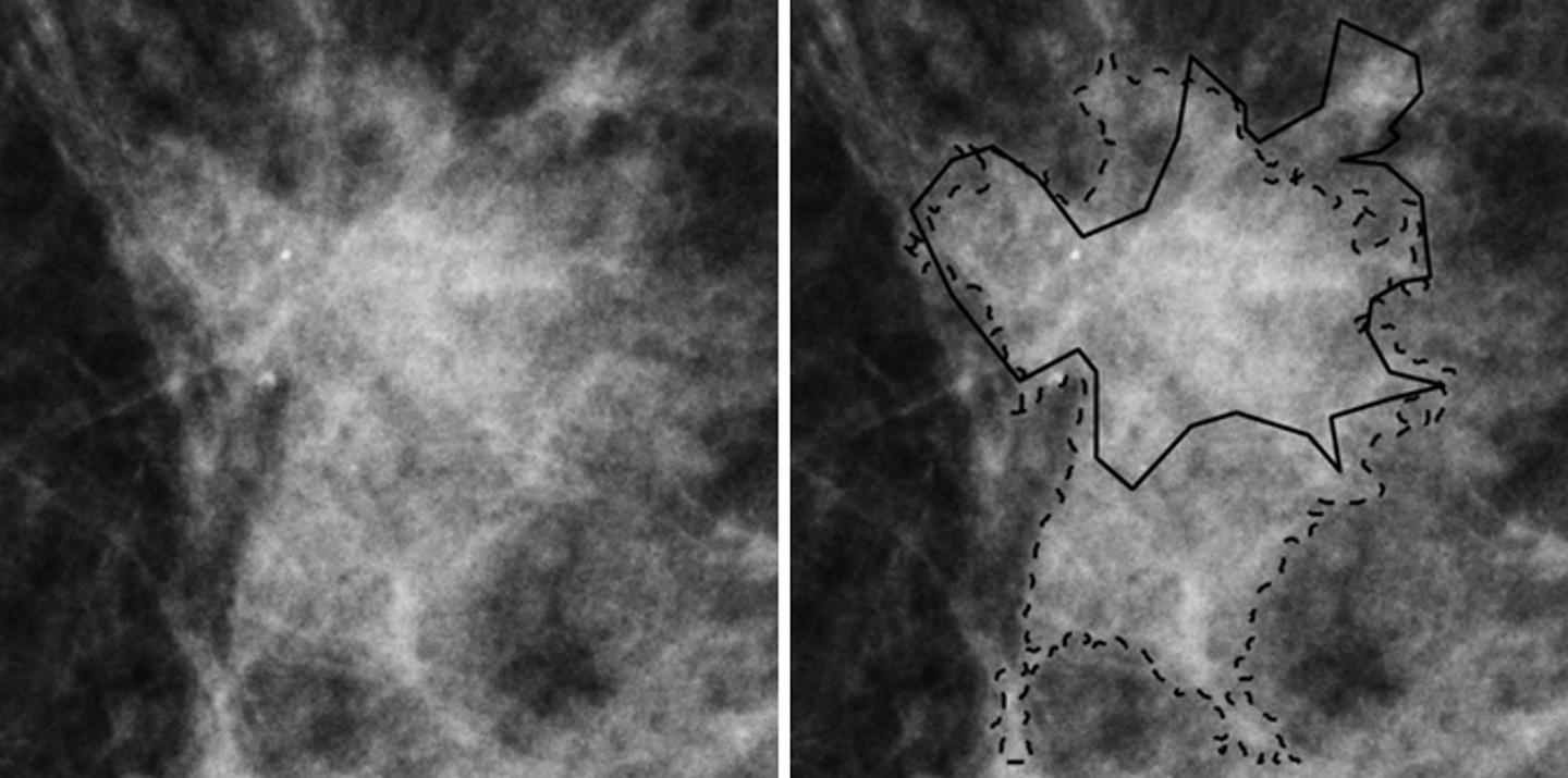 Novel Technique May Significantly Reduce Breast Biopsies 3