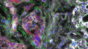 FLC tumor cells