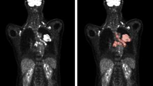 Automated methods enable the analysis of PET/CT scans (left) to accurately predict tumor location and size (right).