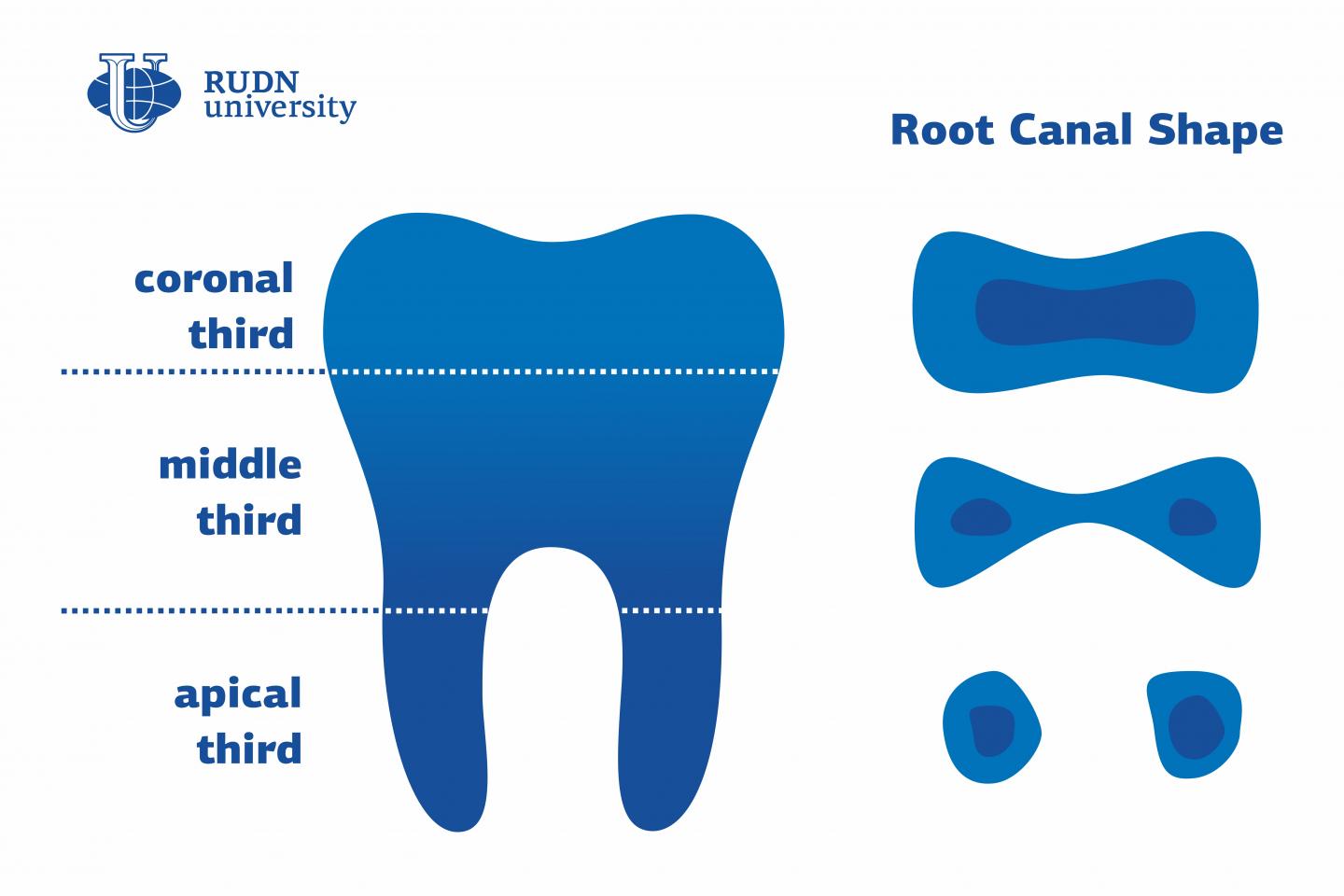 Dentists from RUDN University Presented a New Classification of Root Canal Shape Changes