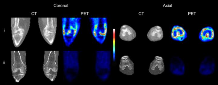 CT and PET SUV Images of Both Knees of an RA Patient and a Healthy Control