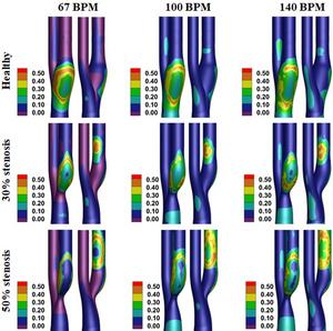 Contours of oscillatory shear index (OSI) on healthy, 30% stenosis, and 50% stenosis carotid arteries