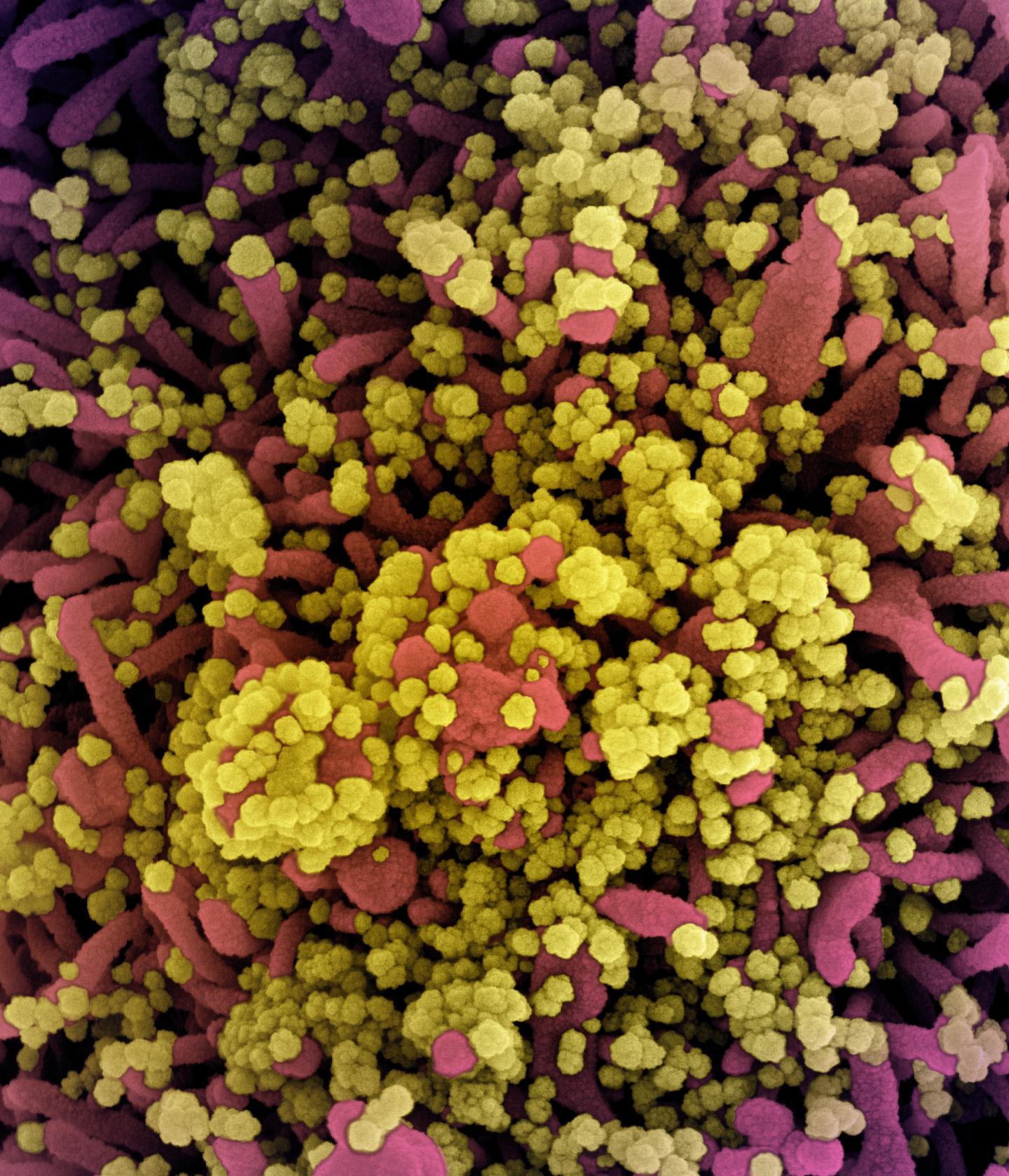 scanning electron micrograph of a cell heavily infected with SARS-CoV-2 virus particles