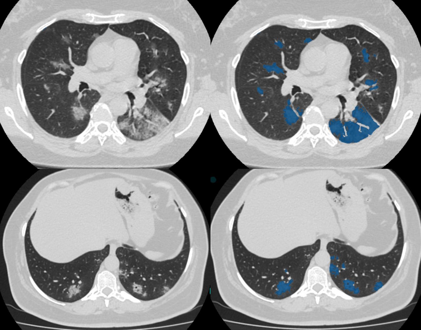 CT scan database of 1000 sets was created for teaching AI to diagnose COVID-19