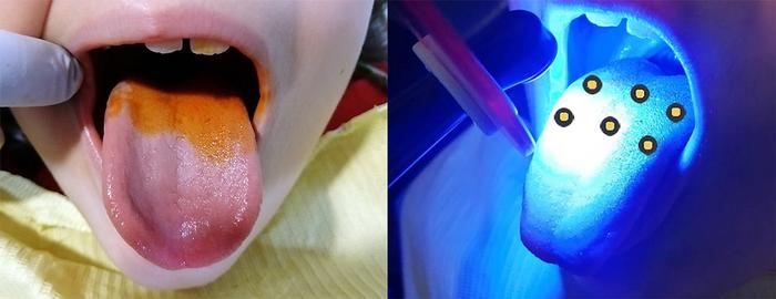 Photodynamic therapy with annatto colorant found to be effective against bad breath