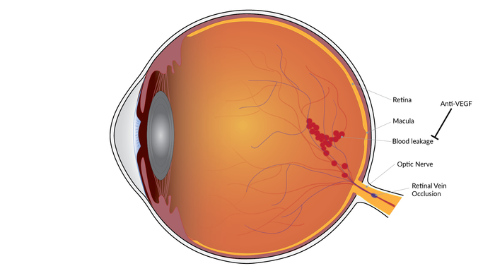 Retinal vein occlusion