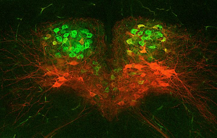 Misfiring motor neurons