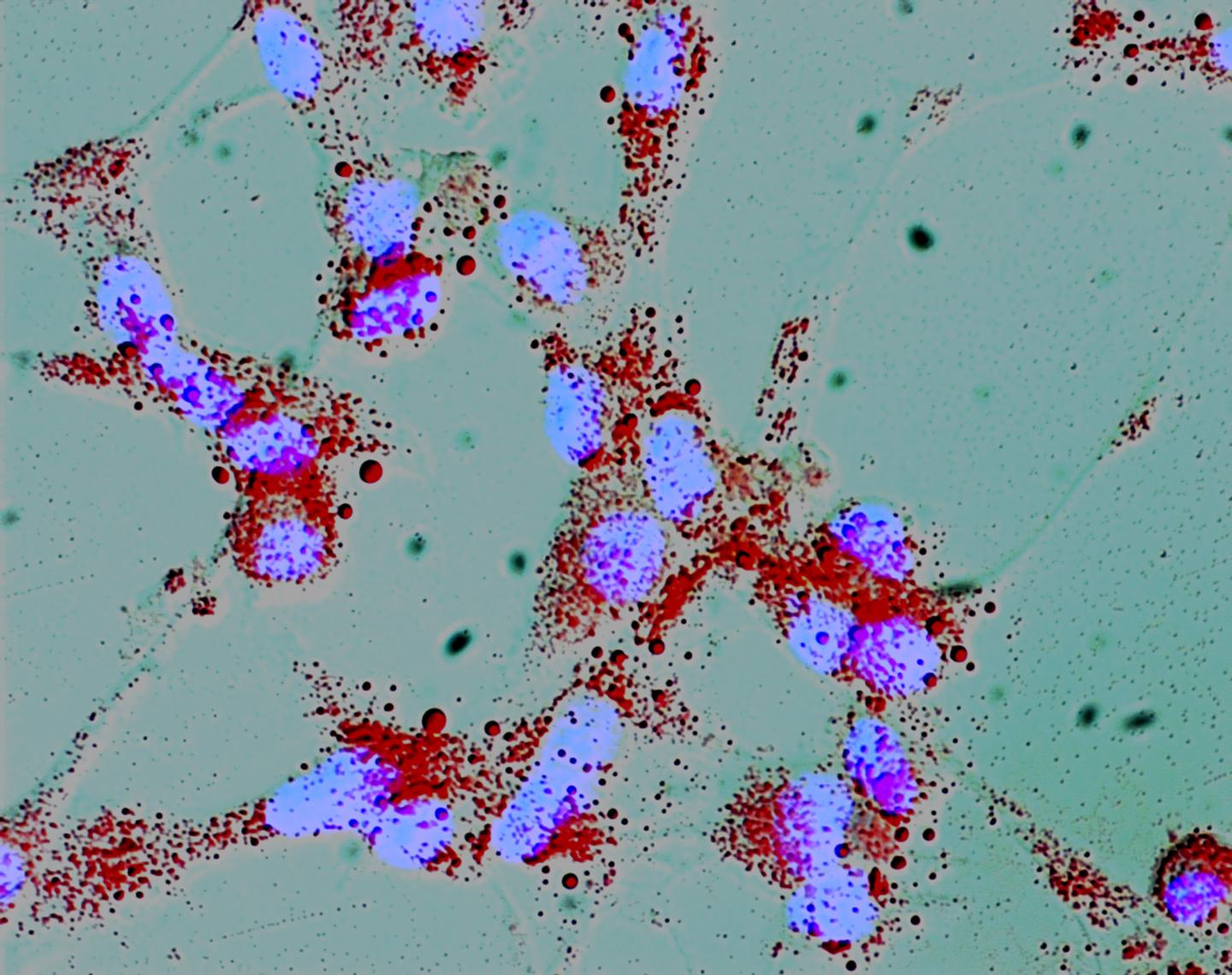 Increased Lipogenesis in Prostate Cancer