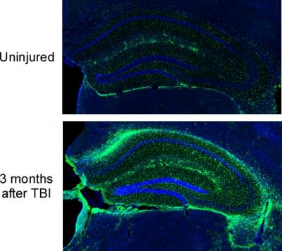 Traumatic brain injury  causes an increase in astrocytes three months after injury
