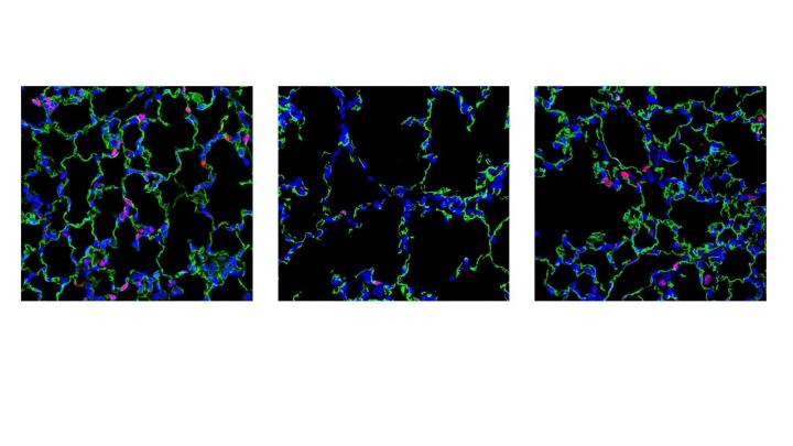 Using Nanoparticles as Potential Treatment for Rare Lung Disease