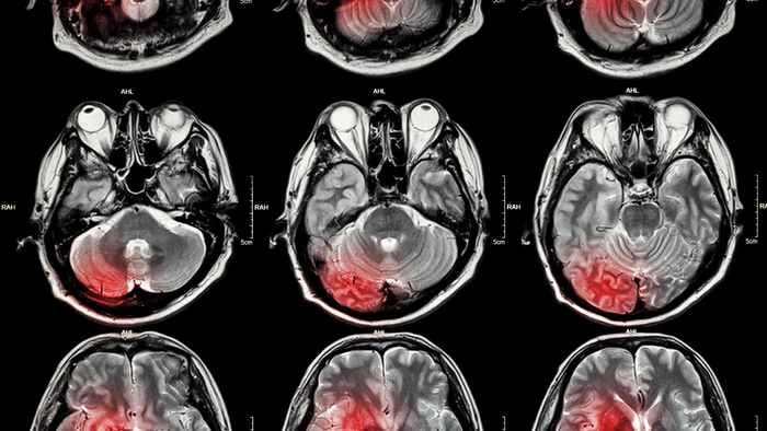 Residential Exposure to Petroleum Refining Could Be Related to Strokes in the Southern United States