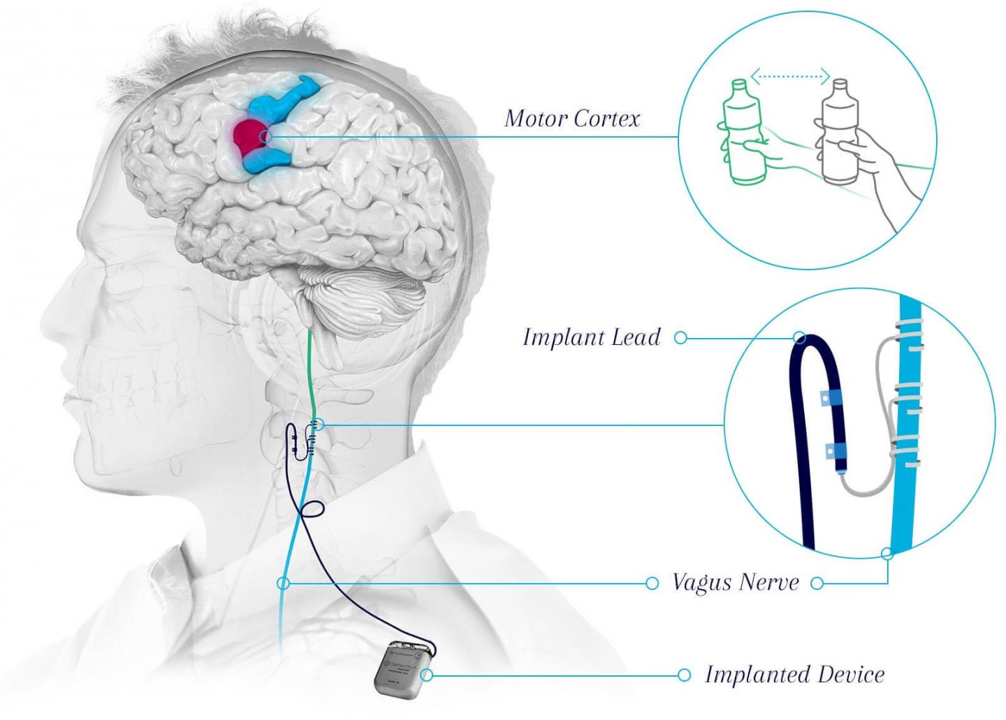 Vagus nerve stimulation implant system