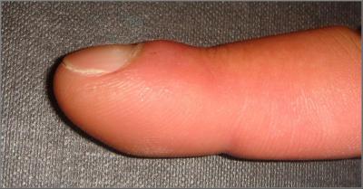 Finger Clubbing (2 of 2)