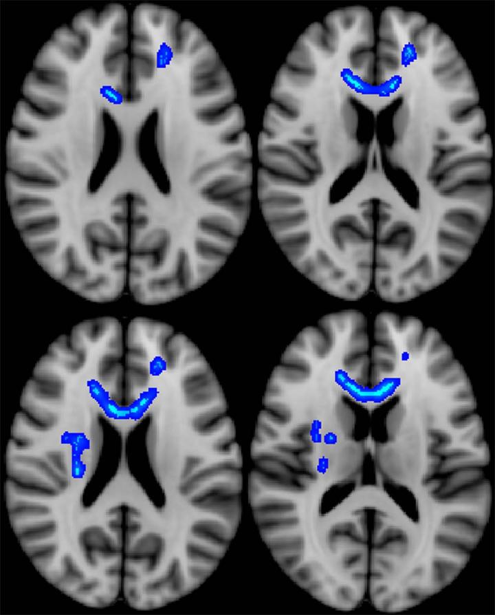 Imaging Predicts Long-Term Effects in Veterans with Brain Injury (1/3)
