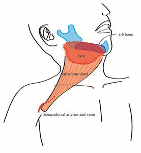 Reconstruction of neck skin and jawbone using a pedicled LD flap