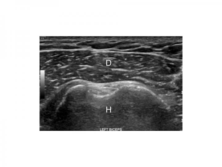 Image of the Normal Deltoid Muscle in An Obese, Non-Diabetic Patient