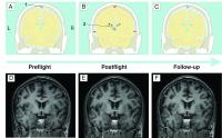 Overview of the Changes Occurring in the Subarachnoid and Intracerebral CSF Spaces