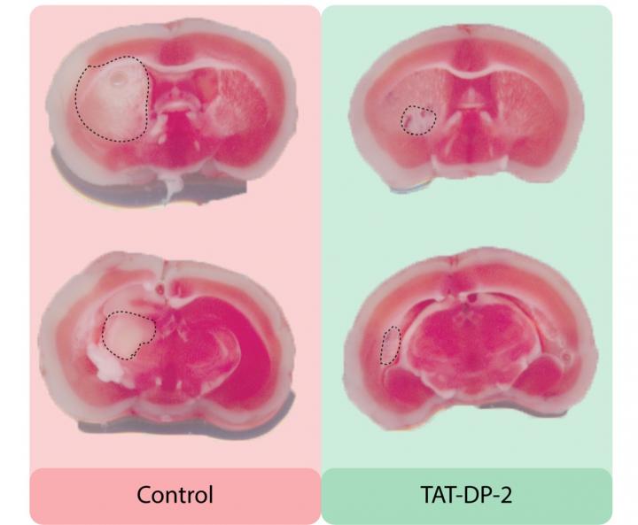 New Drug Prevents Brain Damage after Stroke